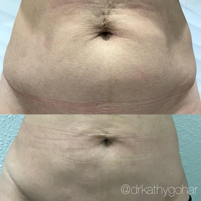 Liposuction before & after